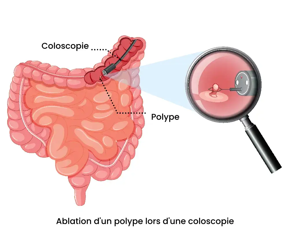 Illustration de l'ablation d'un polype lors d'une coloscopie - Cabinet Jun Li - Bien-être traditionnel chinois